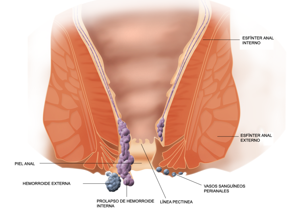 piles treatment