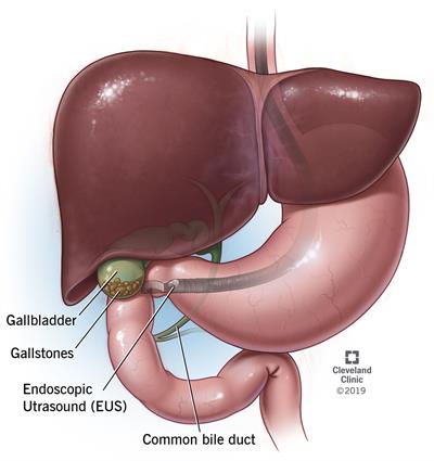 Gallstones Can Be a Pain in The Back