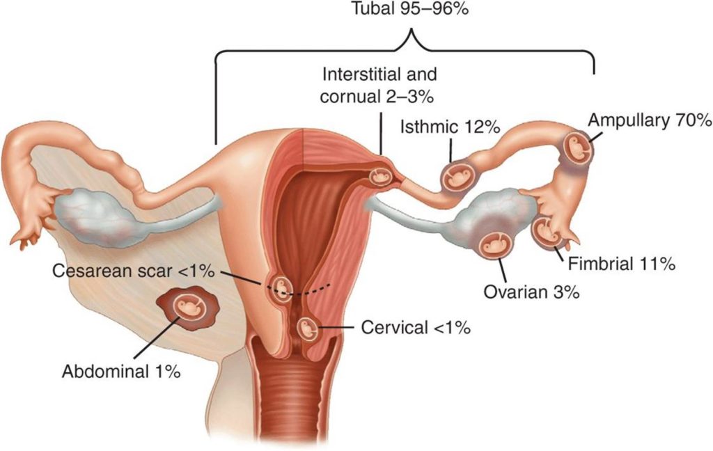 ectopic pregnancy symptoms